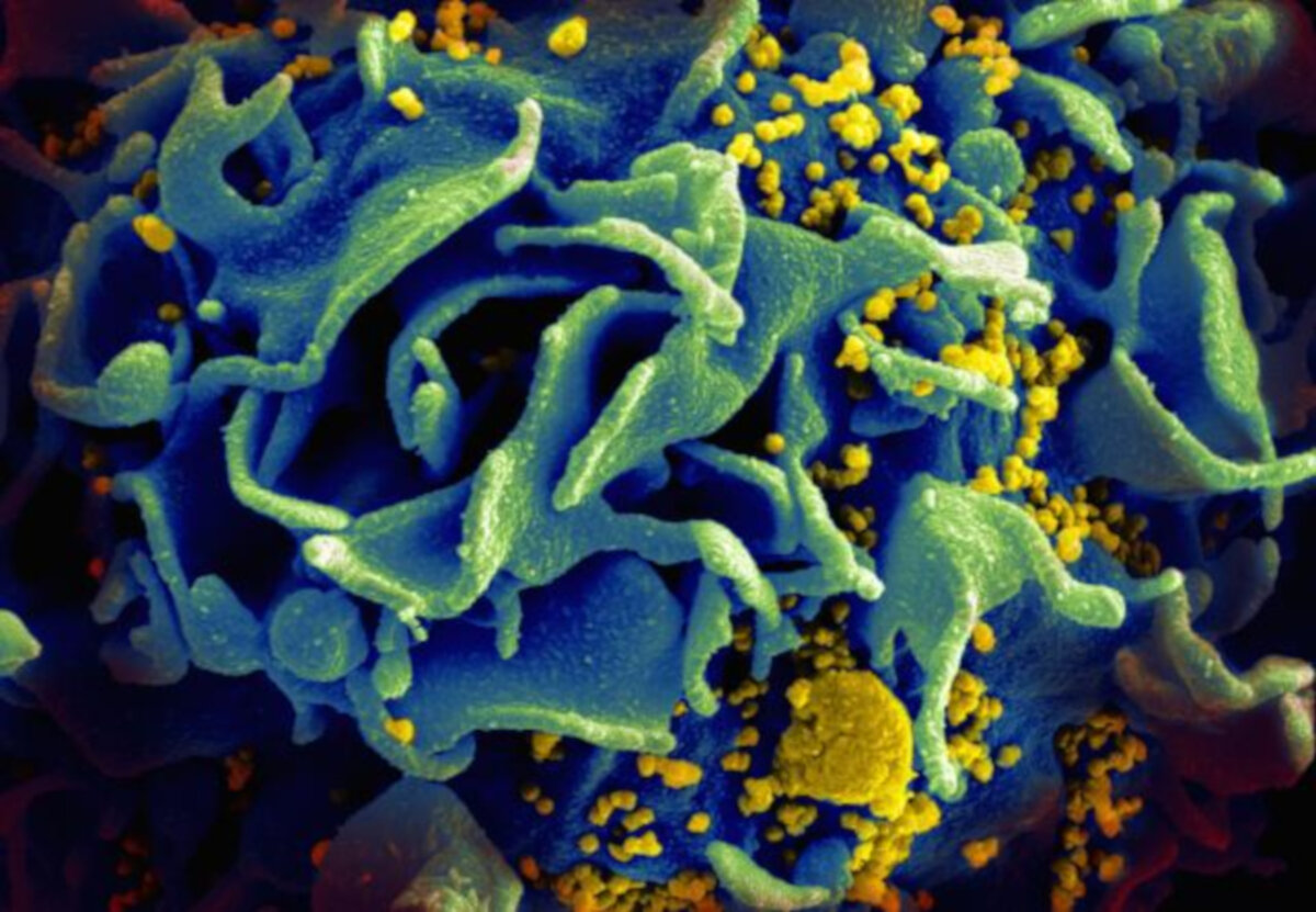 Микроскопическое изображение ВИЧ-инфицированной Т-клетки. Кредит: NIAID